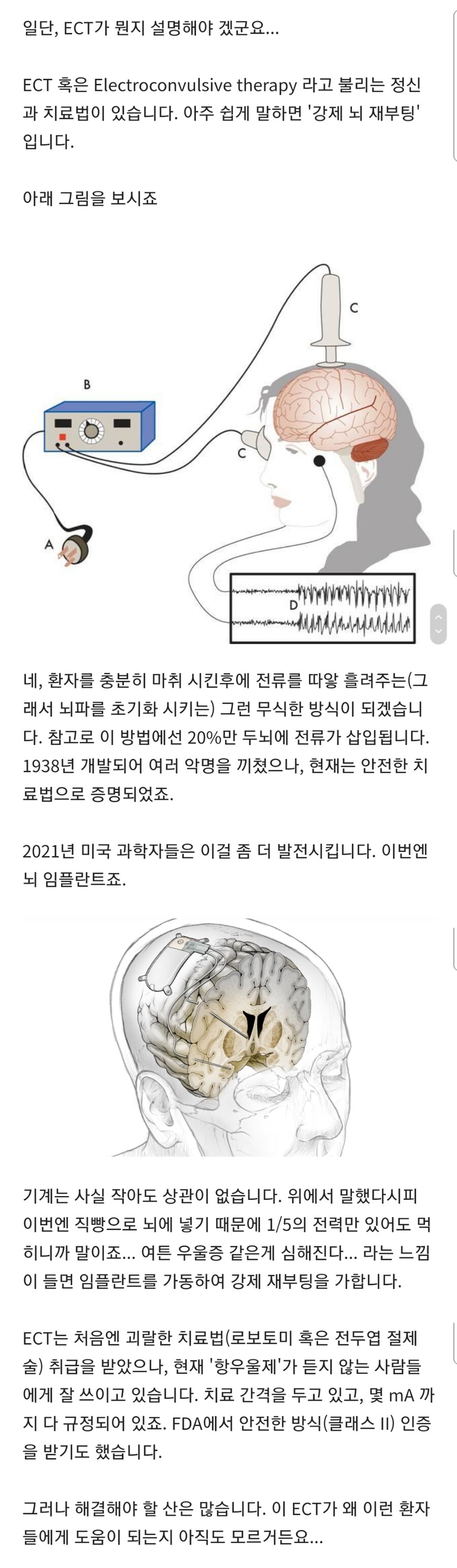 뇌를 강제 재부팅하는 우울증 치료법